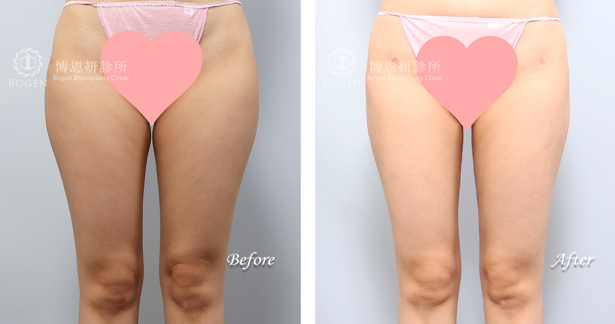 威塑抽脂改善馬鞍肉與大腿脂肪堆積。