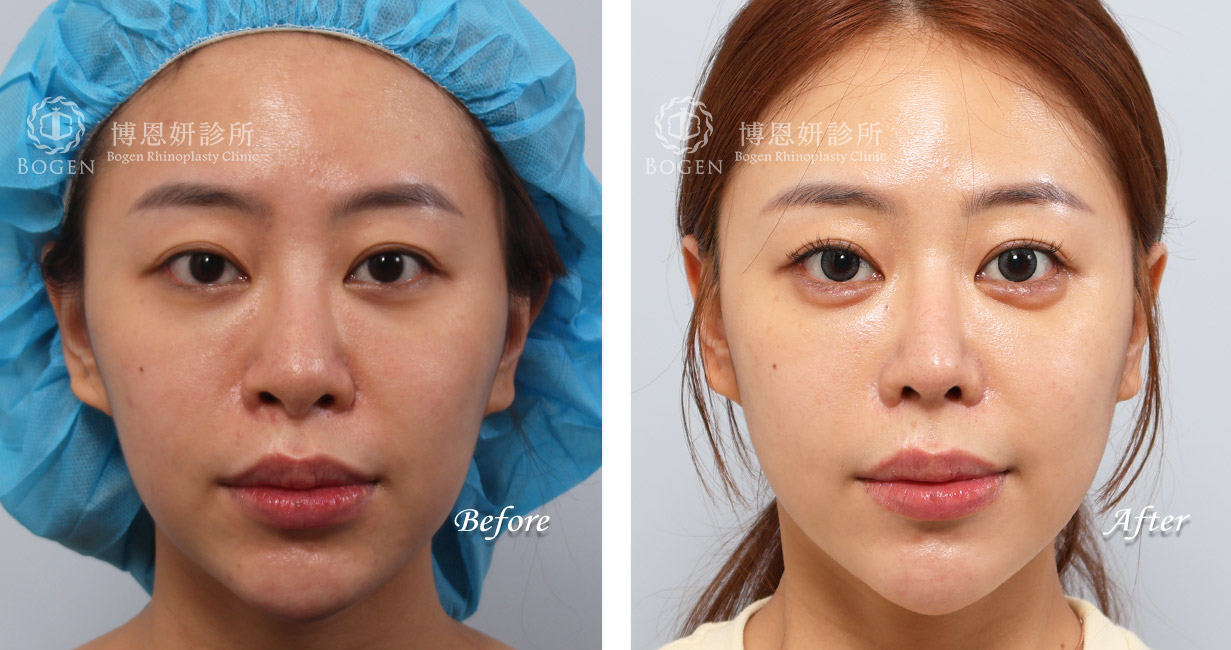 隆鼻手術案例6(博恩妍診所)隆鼻推薦