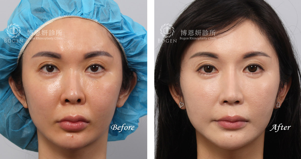 隆鼻手術案例7(博恩妍診所)隆鼻推薦