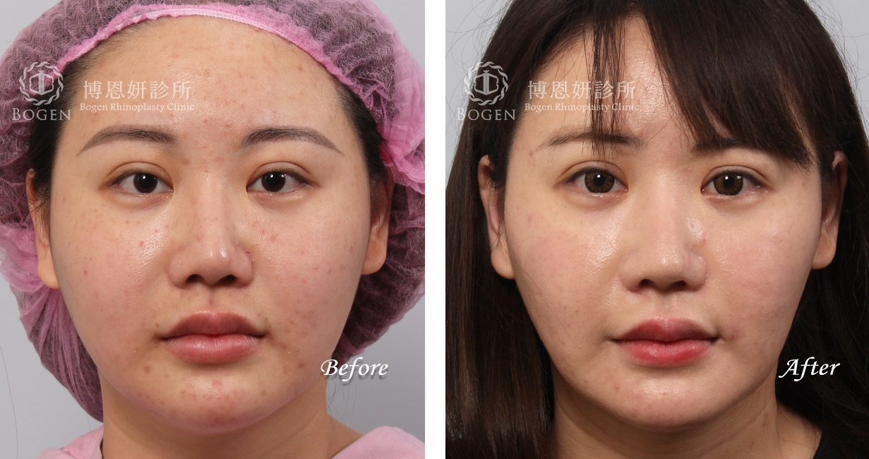 隆鼻手術案例8(博恩妍診所)隆鼻推薦