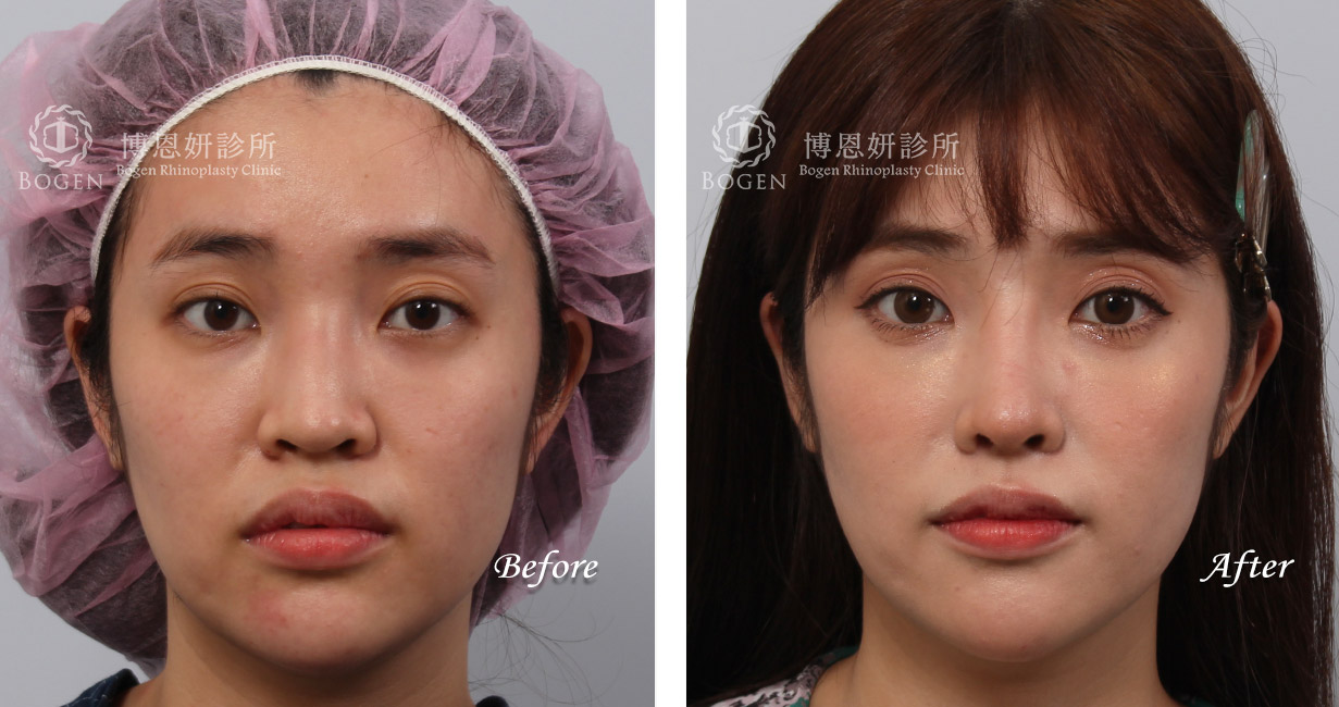 隆鼻手術案例10(博恩妍診所)隆鼻推薦