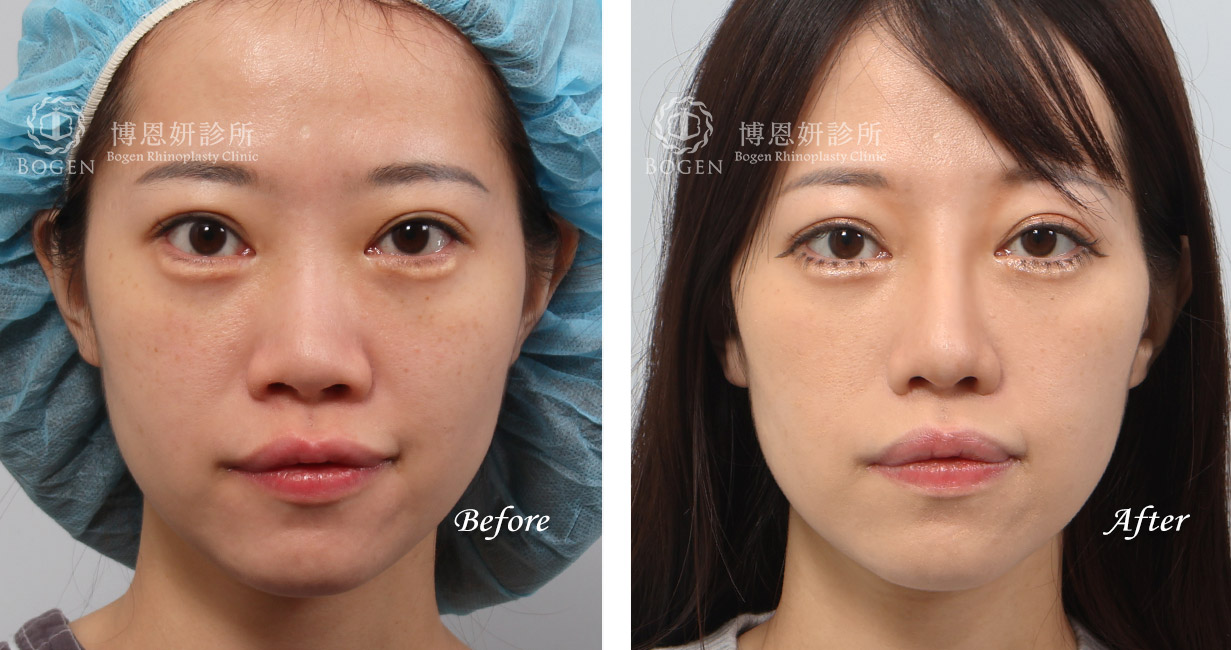 隆鼻手術案例11(博恩妍診所)隆鼻推薦