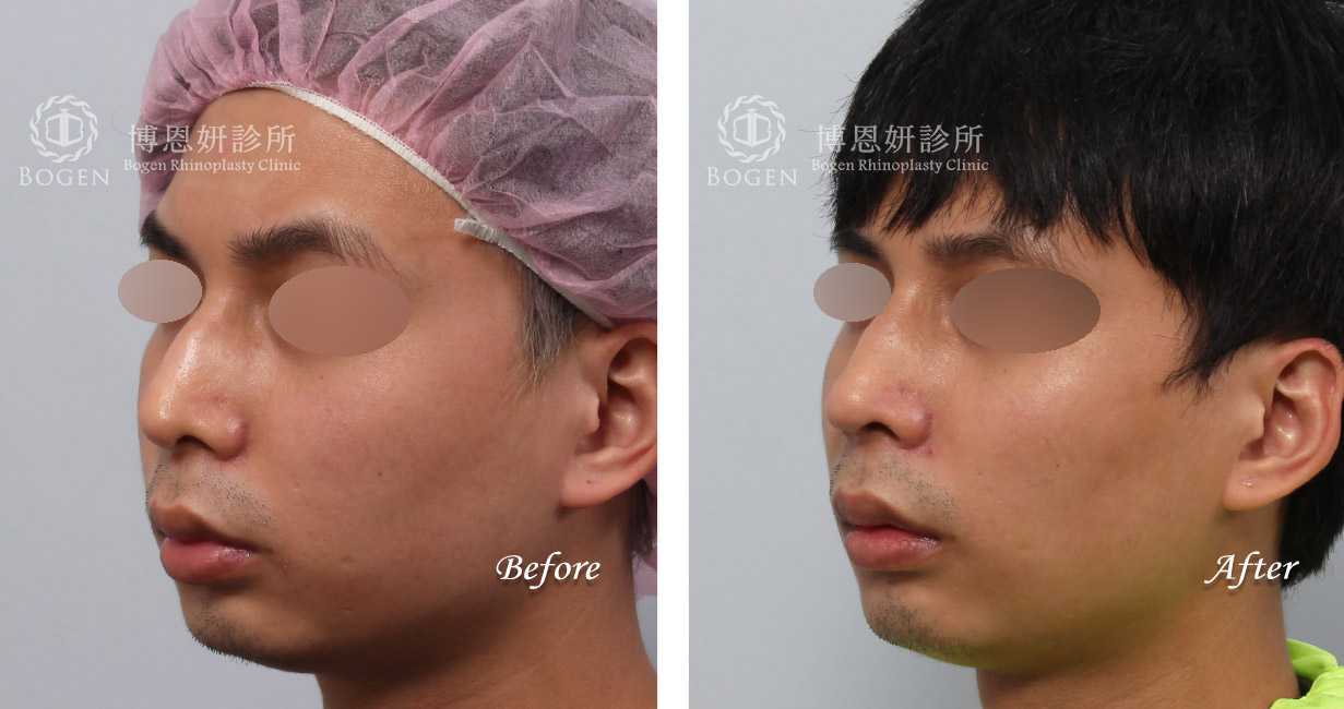 隆鼻手術前後照片比對男性案例,隆鼻手術推薦,張簡醫師