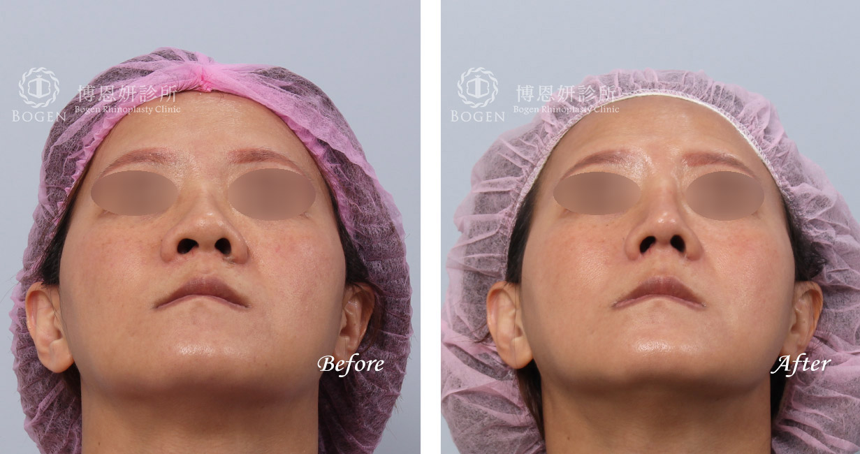 縮鼻翼權威張簡醫師幫你解決鼻翼過大問題，縮鼻翼給你秀氣精緻的鼻形。