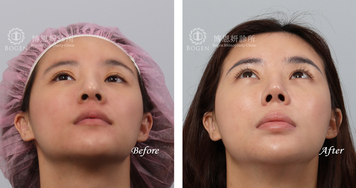 縮鼻翼手術推薦：博恩妍診所，縮鼻翼權威，張簡醫師