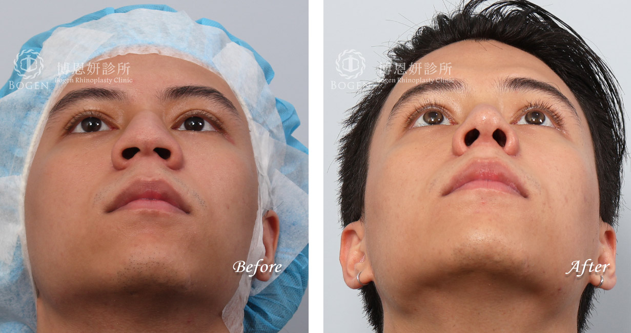 隆鼻手術分享-男性隆鼻手術術前術後照案例,無假體異體真皮隆鼻,縮鼻翼,海鷗線