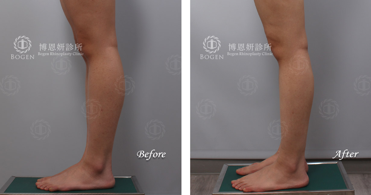 小腿抽脂+小腿肉毒