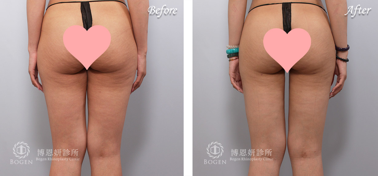 威塑抽脂改善馬鞍肉與大腿脂肪堆積。