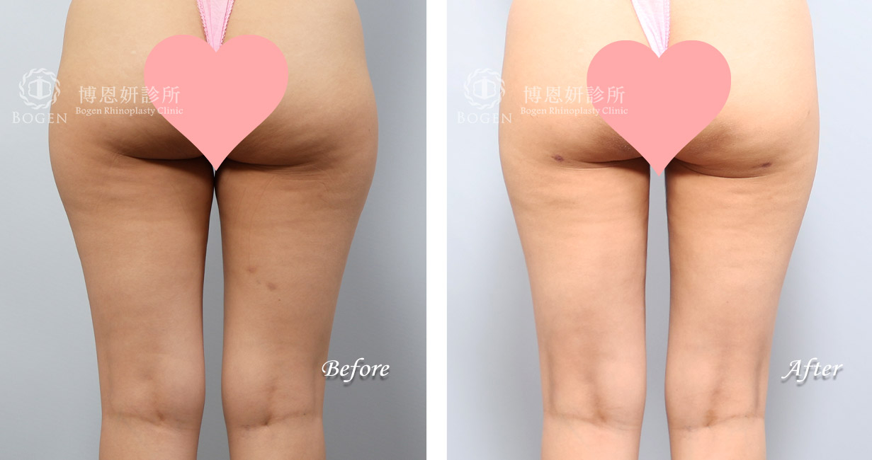 威塑抽脂改善馬鞍肉與大腿脂肪堆積。
