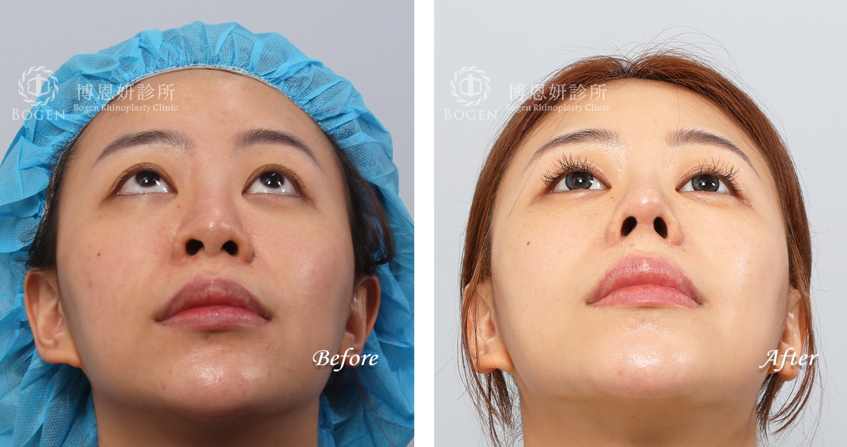 縮鼻翼推薦博恩妍診所張簡醫師縮鼻翼權威