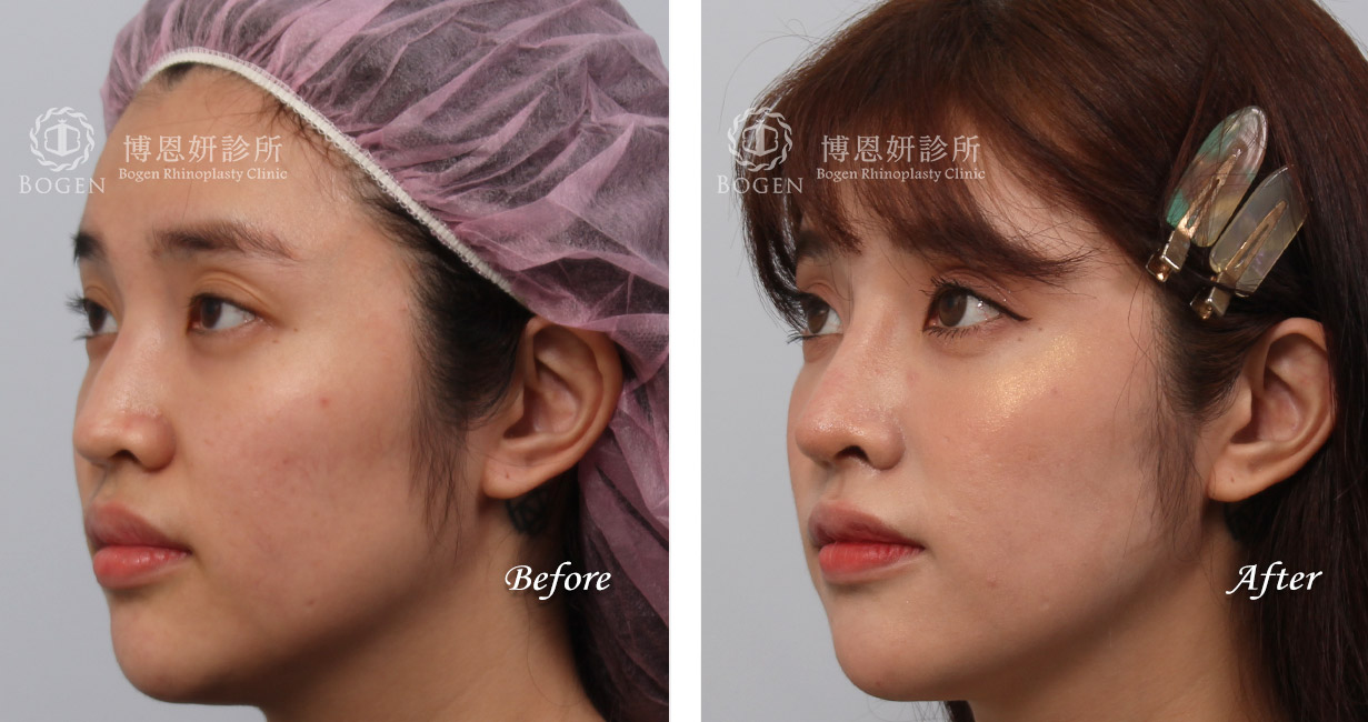 縮鼻翼手術推薦－博恩妍診所（張簡醫師）縮鼻翼權威