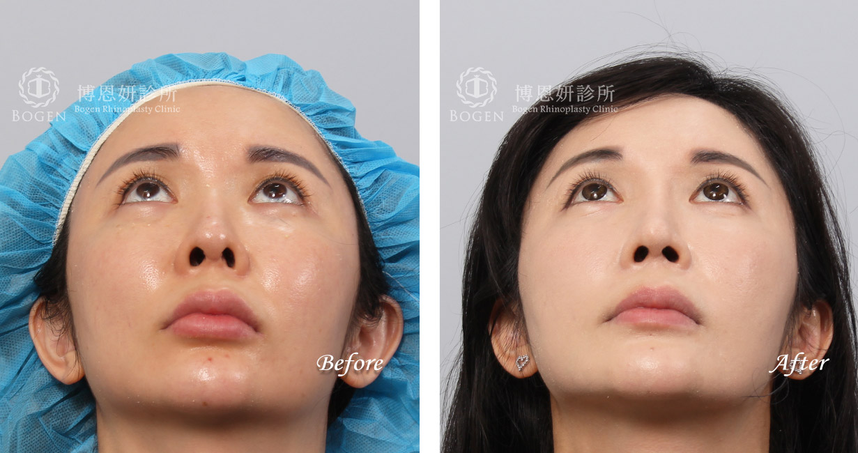 隆鼻手術案例7(博恩妍診所)隆鼻推薦