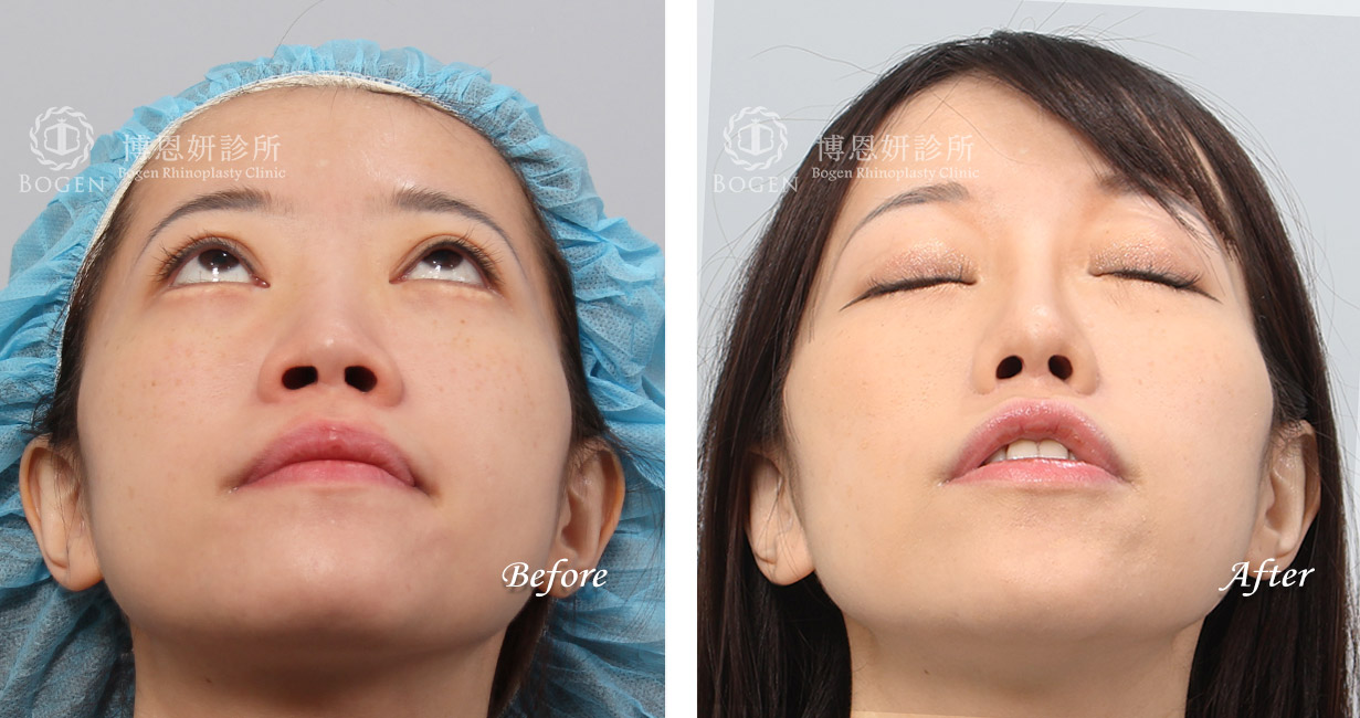 隆鼻手術案例11(博恩妍診所)隆鼻推薦