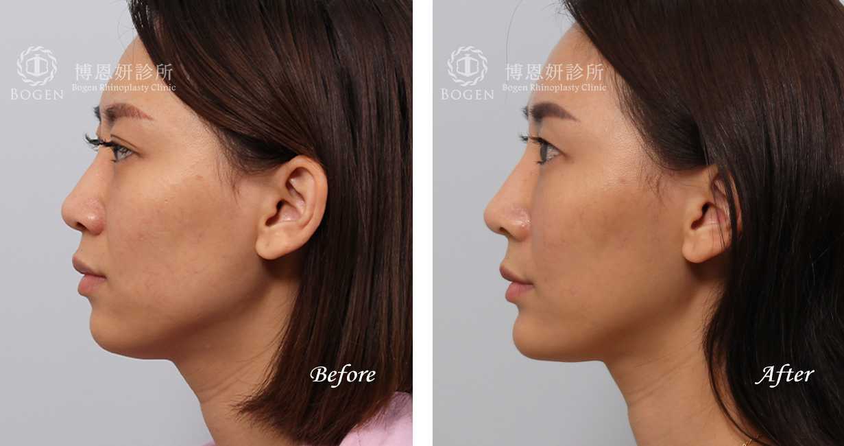 張簡醫師縮鼻翼權威，縮鼻翼術前術後照片