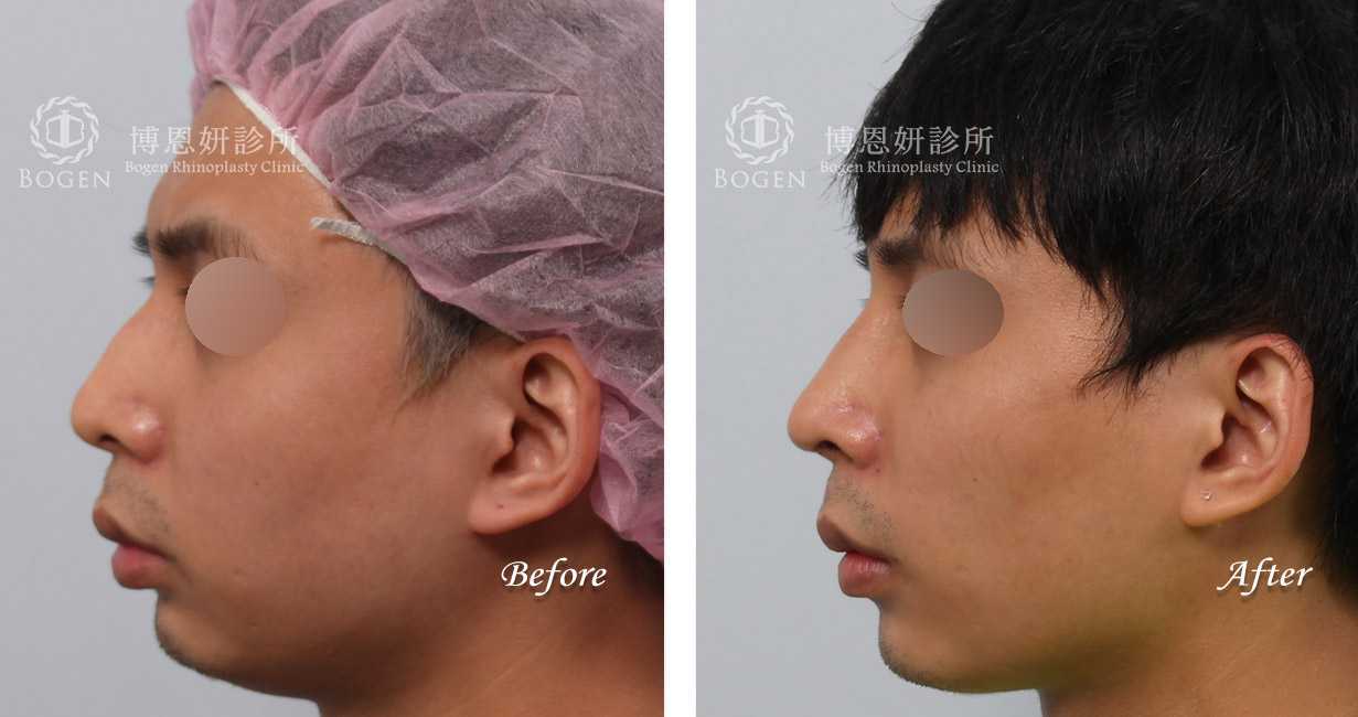 男鼻整形,隆鼻男性,鼻整形無假體異體真皮隆鼻,縮鼻翼鼻整形,海鷗線鼻整形