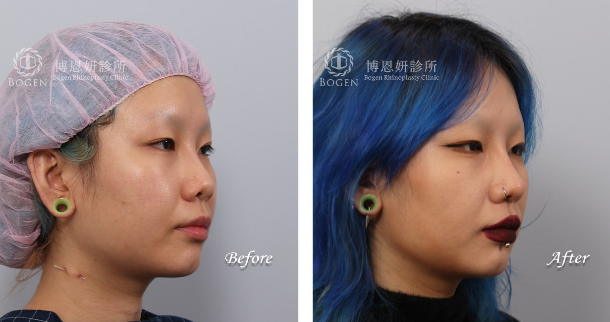 隆鼻手術案例,博恩妍診所隆鼻手術術前術後照