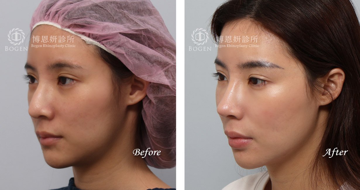 隆鼻手術案例,博恩妍診所隆鼻手術術前術後照,隆鼻推薦張簡醫師
