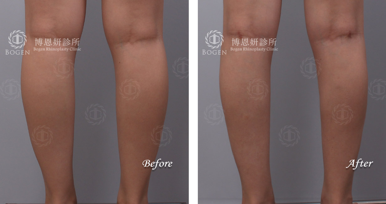 小腿抽脂改善脂肪堆積問題