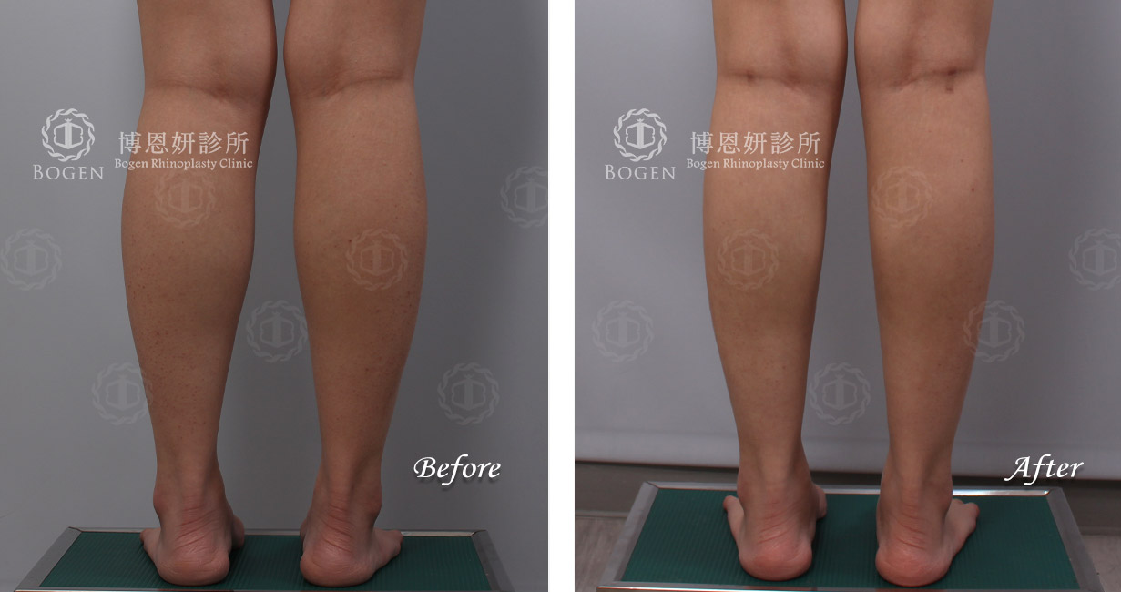 小腿抽脂+小腿肉毒