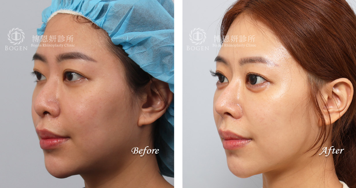 隆鼻手術案例6(博恩妍診所)隆鼻推薦