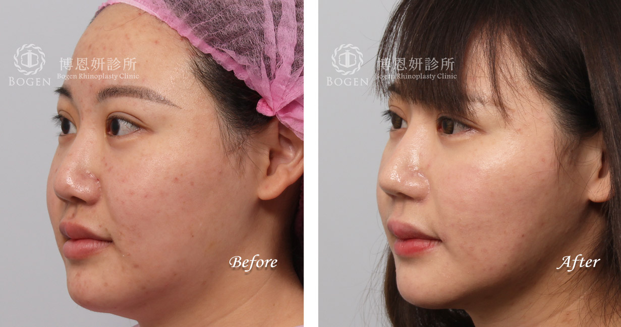 隆鼻手術案例8(博恩妍診所)隆鼻推薦