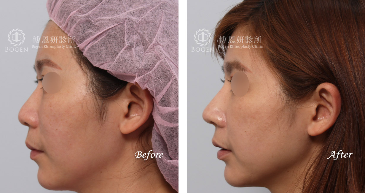 隆鼻手術案例9(博恩妍診所)隆鼻推薦