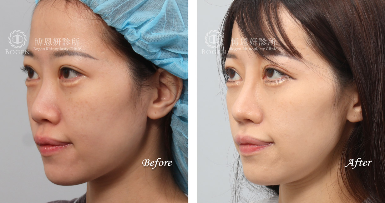 隆鼻手術案例11(博恩妍診所)隆鼻推薦