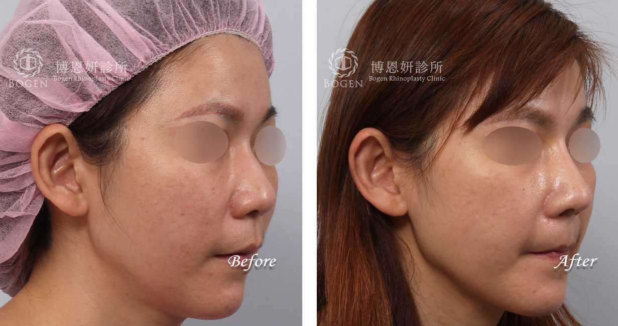 鼻整形術前術後照鼻整形案例18,鼻整形手術推薦博恩妍診所張簡醫師