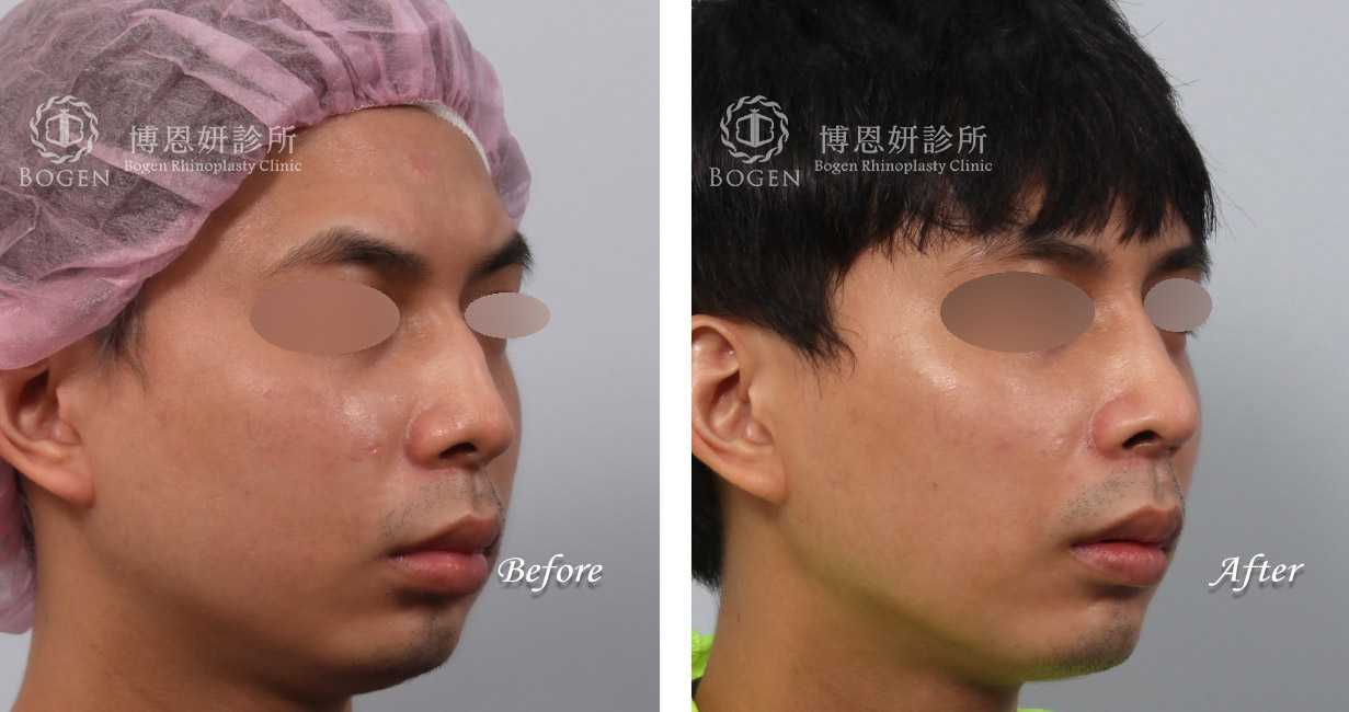 男鼻整形,隆鼻男性,鼻整形無假體異體真皮隆鼻,縮鼻翼鼻整形,海鷗線鼻整形