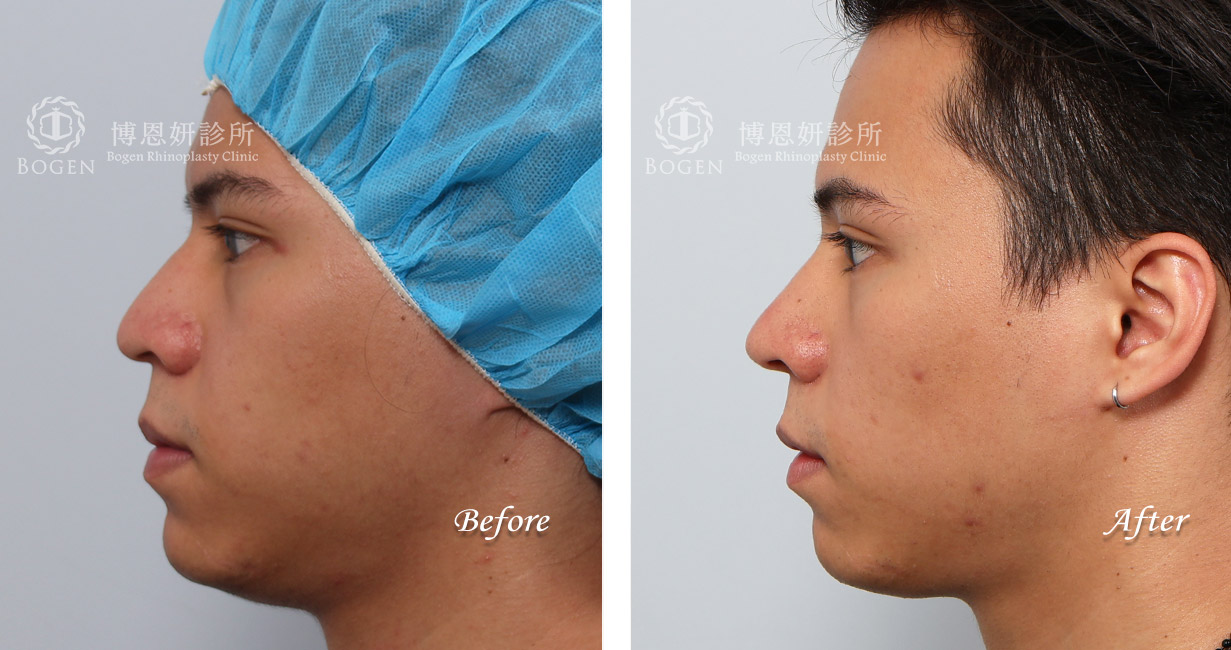 縮鼻翼推薦,男性隆鼻,無假體異體真皮隆鼻,縮鼻翼,海鷗線,張簡醫師縮鼻翼權威