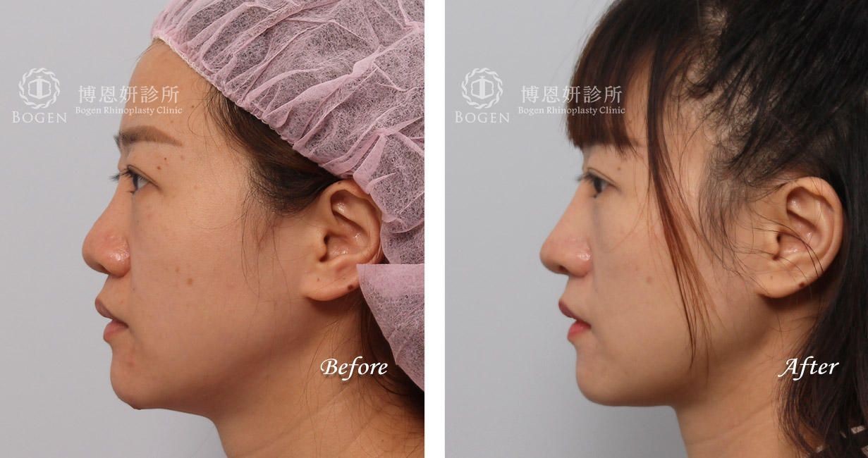 縮鼻翼術前術後照：博恩妍診所張簡醫師縮鼻翼權威
