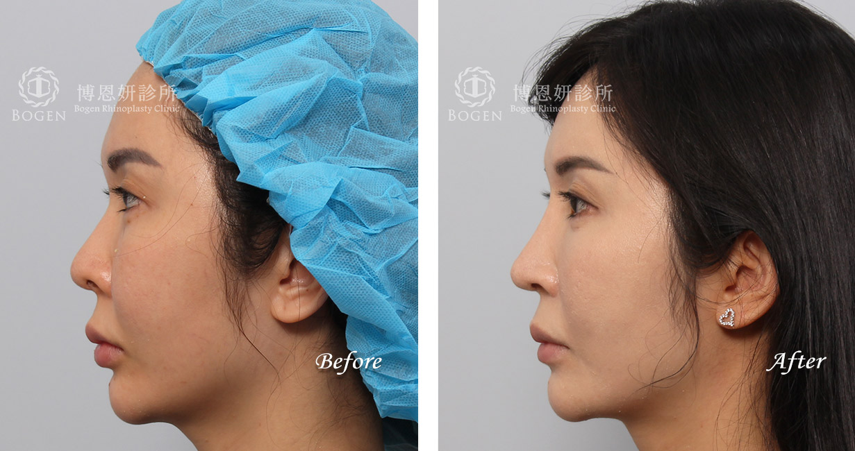 隆鼻手術案例7(博恩妍診所)隆鼻推薦