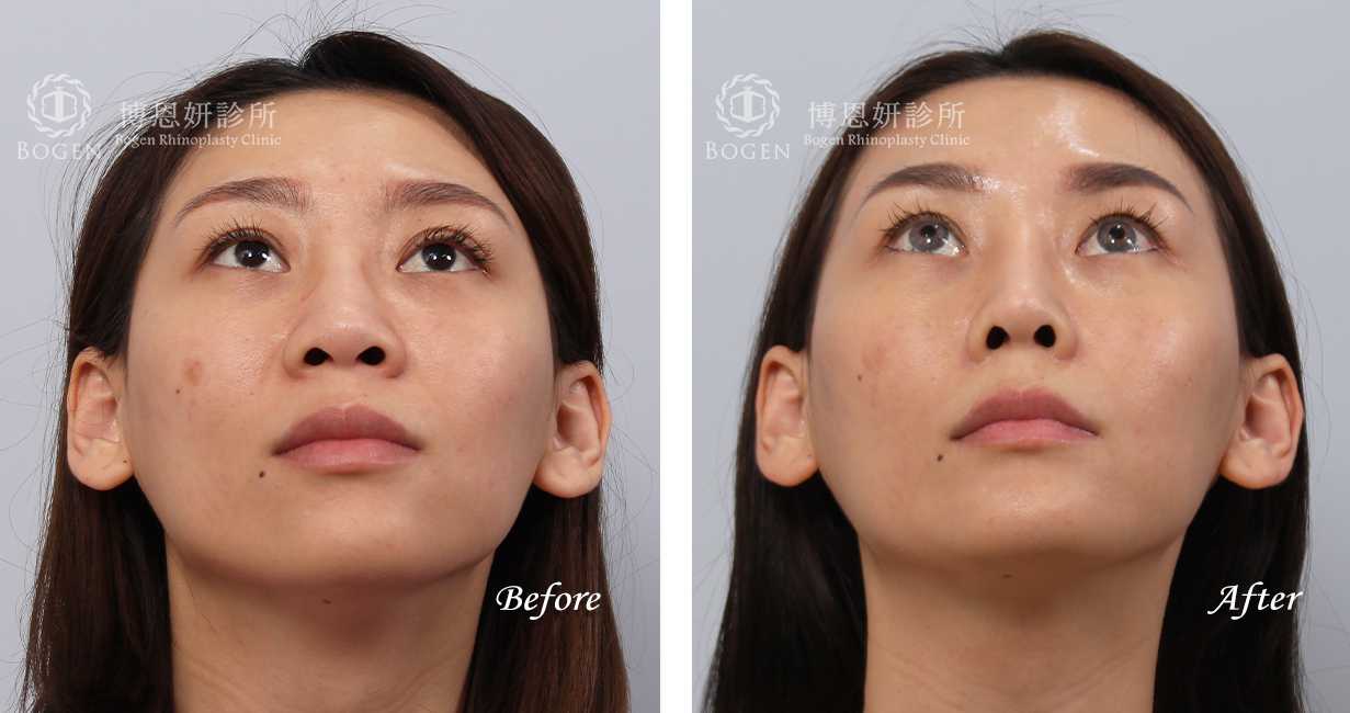 張簡醫師縮鼻翼權威，縮鼻翼術前術後照片