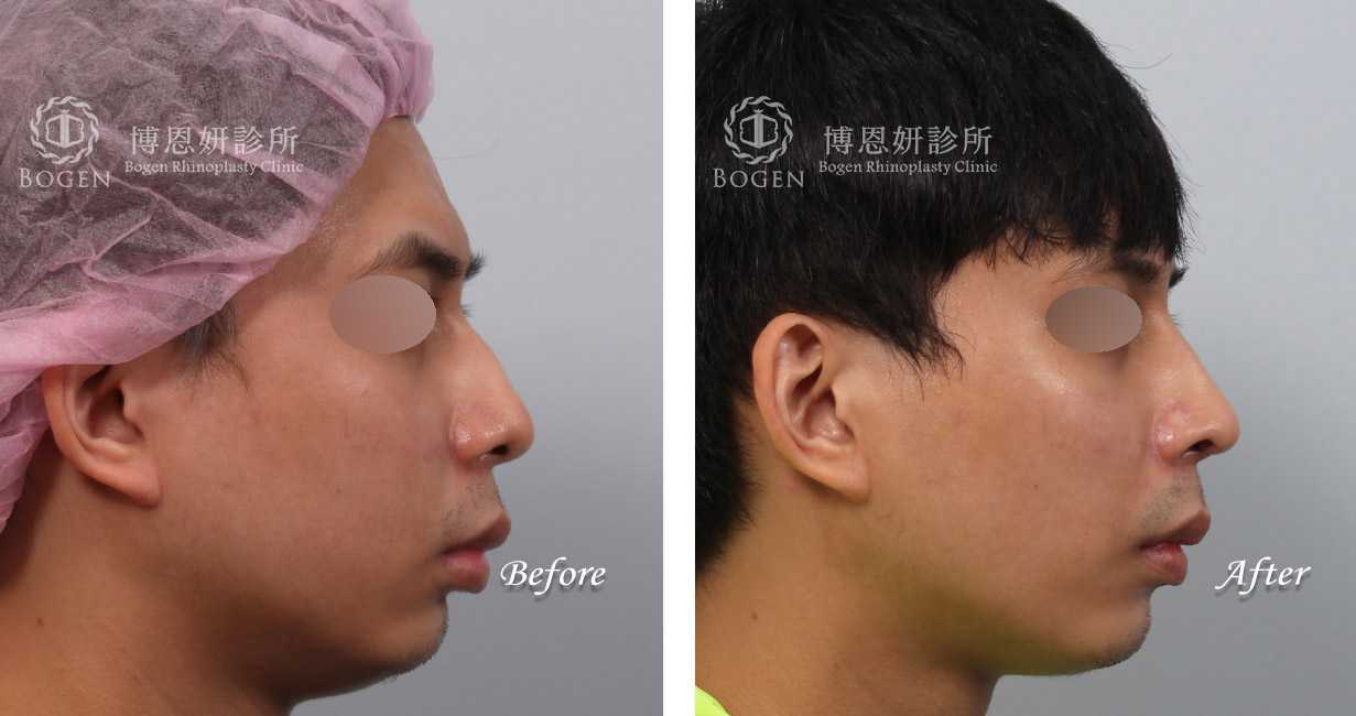 隆鼻手術前後照片比對男性案例,隆鼻手術推薦,張簡醫師