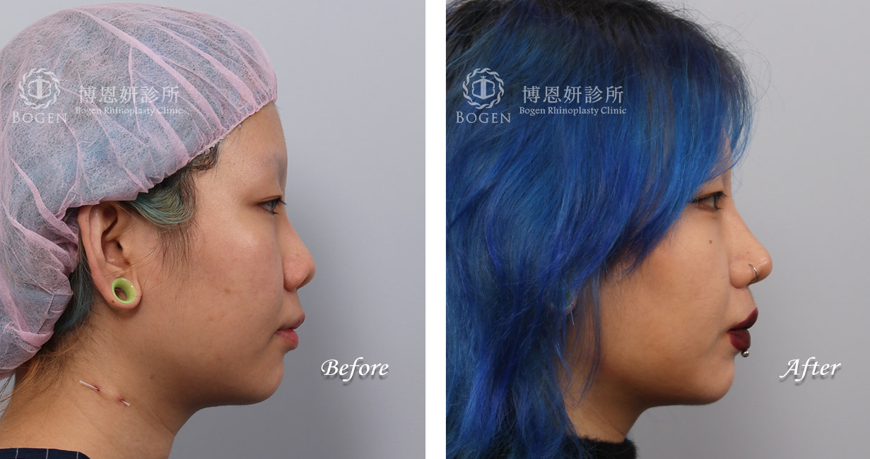 鼻整形術前術後照鼻整形案例22,鼻整形手術推薦博恩妍診所張簡醫師