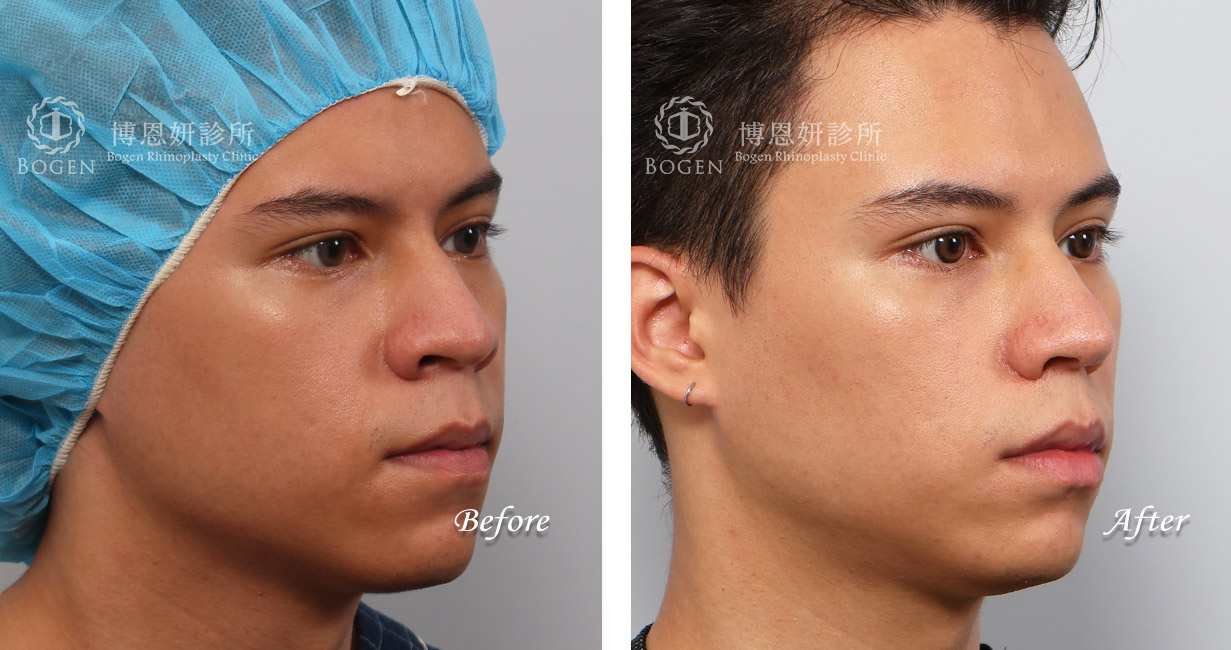 縮鼻翼推薦,男性隆鼻,無假體異體真皮隆鼻,縮鼻翼,海鷗線,張簡醫師縮鼻翼權威