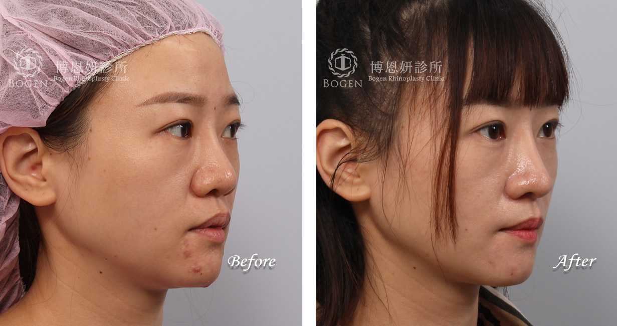 縮鼻翼術前術後照：博恩妍診所張簡醫師縮鼻翼權威