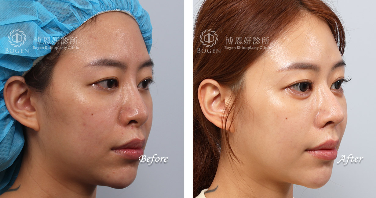 隆鼻手術案例6(博恩妍診所)隆鼻推薦