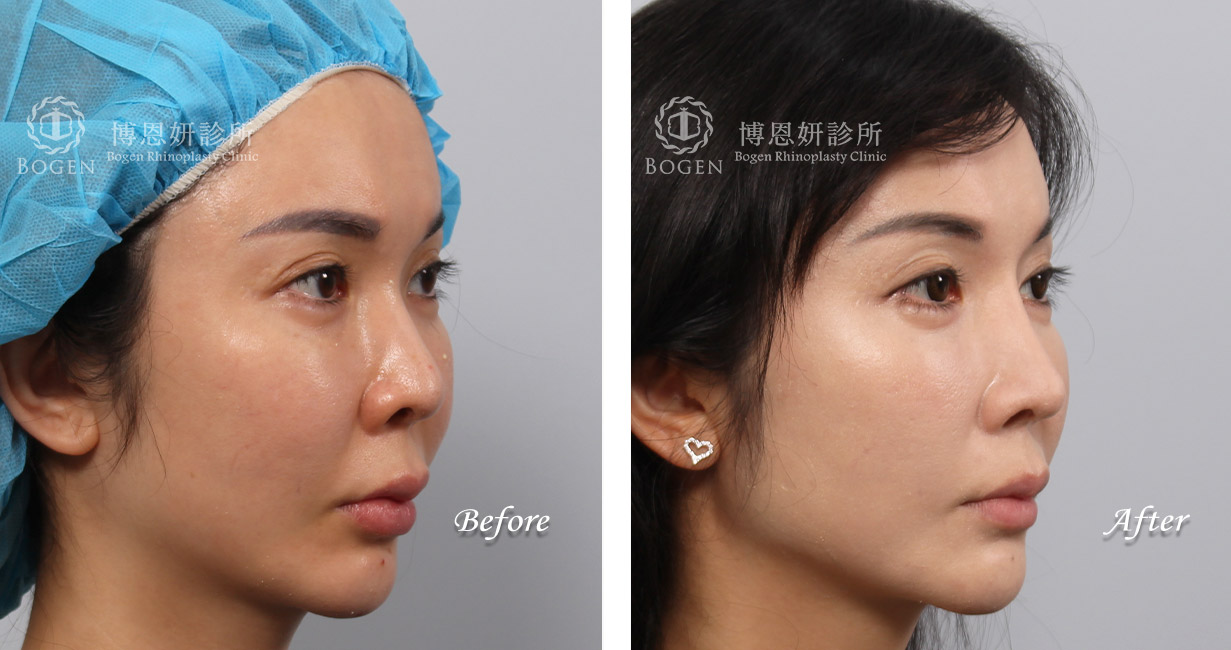 隆鼻手術案例7(博恩妍診所)隆鼻推薦