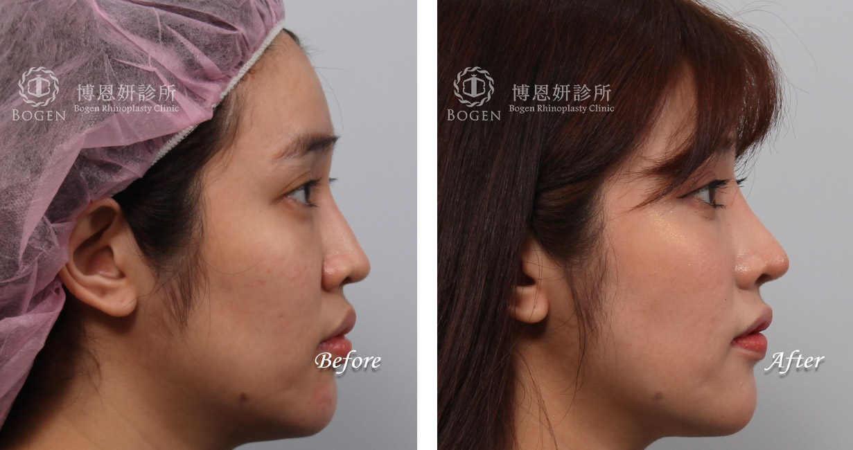 隆鼻手術案例10(博恩妍診所)隆鼻推薦