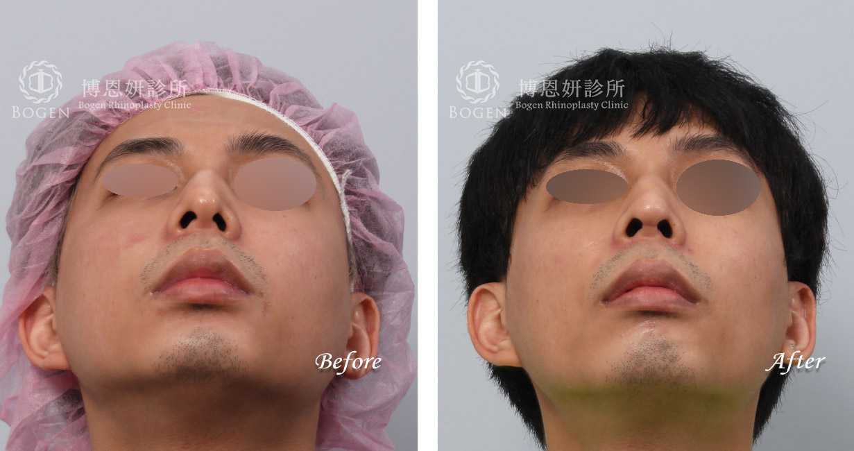 隆鼻手術前後照片比對男性案例,隆鼻手術推薦,張簡醫師