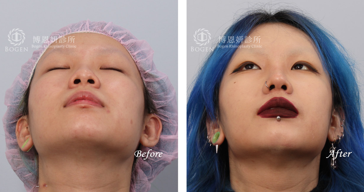鼻整形術前術後照鼻整形案例22,鼻整形手術推薦博恩妍診所張簡醫師
