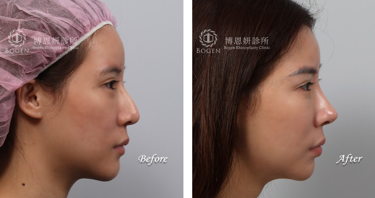 鼻整形術前術後照鼻整形案例25,鼻整形手術推薦博恩妍診所張簡醫師