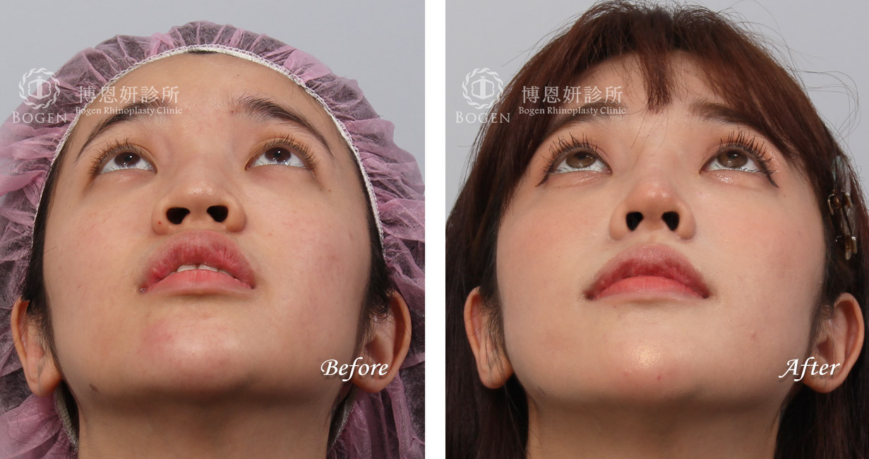 縮鼻翼手術推薦－博恩妍診所（張簡醫師）縮鼻翼權威