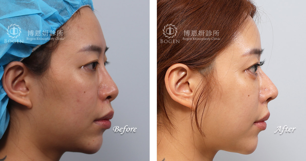 縮鼻翼推薦博恩妍診所張簡醫師縮鼻翼權威