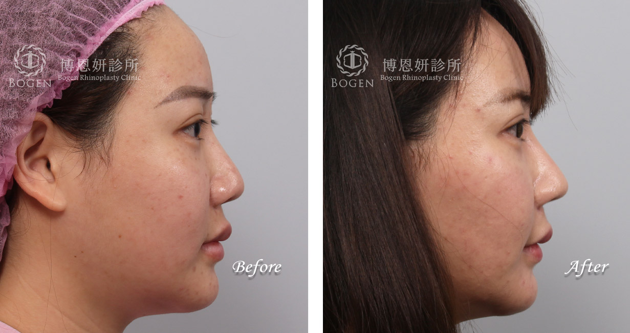 隆鼻手術案例8(博恩妍診所)隆鼻推薦