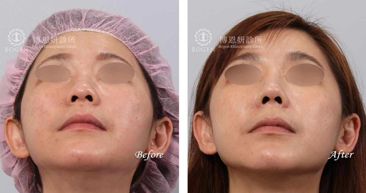 隆鼻手術案例9(博恩妍診所)隆鼻推薦