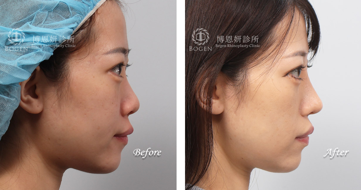 隆鼻手術案例11(博恩妍診所)隆鼻推薦