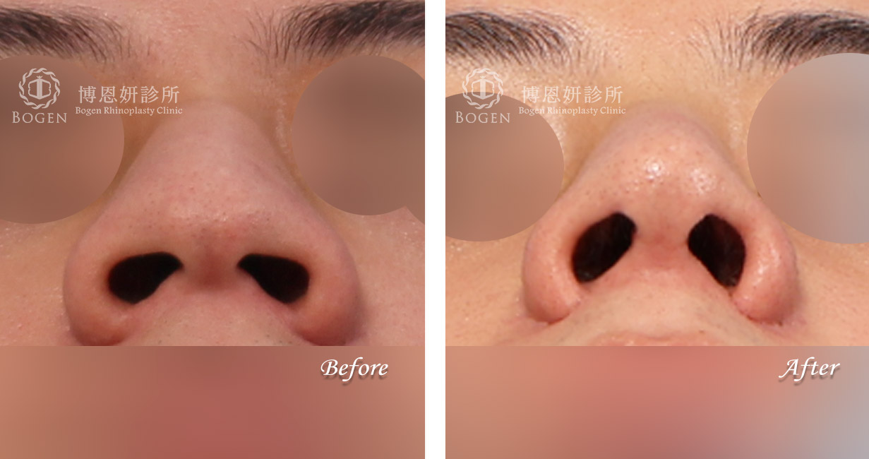 縮鼻翼推薦,男性隆鼻,無假體異體真皮隆鼻,縮鼻翼,海鷗線,張簡醫師縮鼻翼權威
