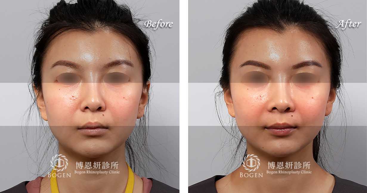 臉部整形手術中，法令紋貴族手術是治療法令紋手術的其中一個環節。有的患者可能曾經利用玻尿酸，電波拉皮治療過法令紋凹陷，或是利用異體真皮粉進行過鼻基底法令紋填充。對於中臉凹陷成有法令紋改善的期望患者，可以考慮利用手法令紋手術來改善。
博恩妍診所法令紋貴族手術均為客製化量身定做，患者前來進行法令紋面診時均會利用3D電腦斷層進行法令紋中臉凹陷的評估，並詳細解釋不論是人工植體或是異體真皮貴族手術的材質差異。讓患者確實理解手術效果後再進行手術。